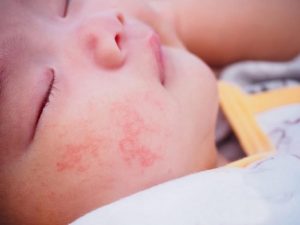 Ở trẻ nhỏ, nấm Candida không chỉ nổi trên da mặt mà nhiều nơi